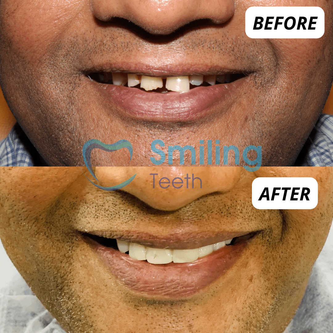 Crown and Tooth Bridges Treatment - Before & After