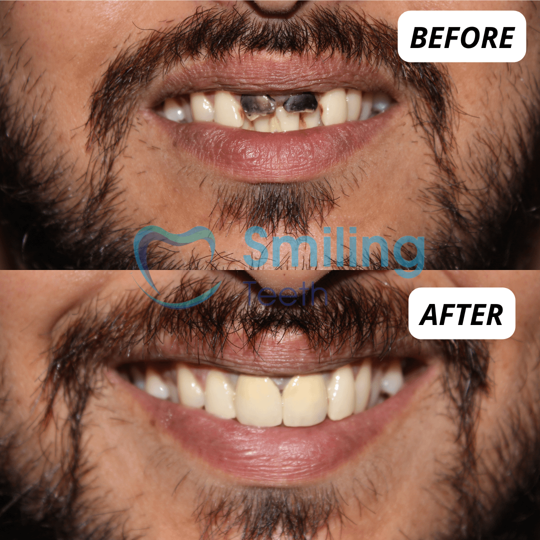 Best Smile Makeover Dentist - Before and After