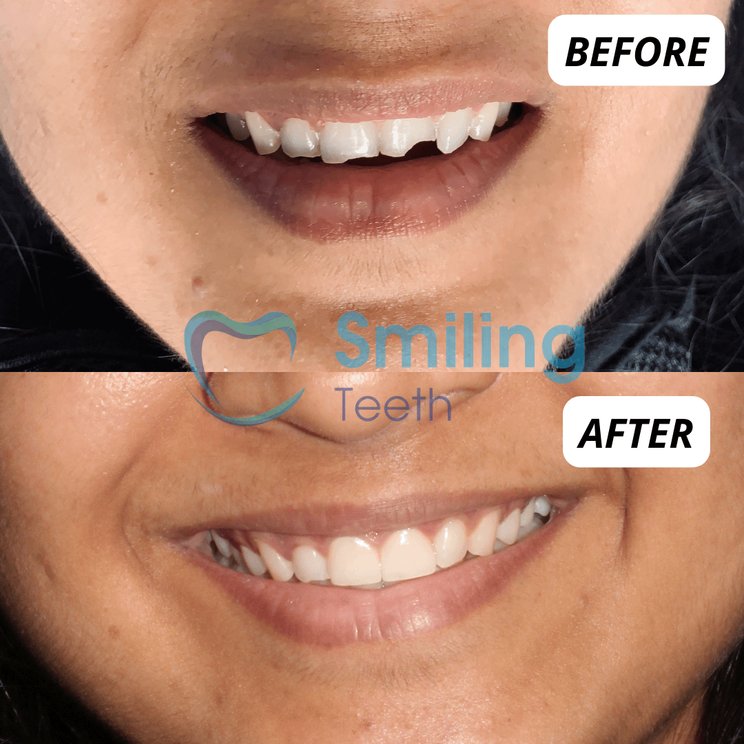 Smile Makeover Treatment- Before & After