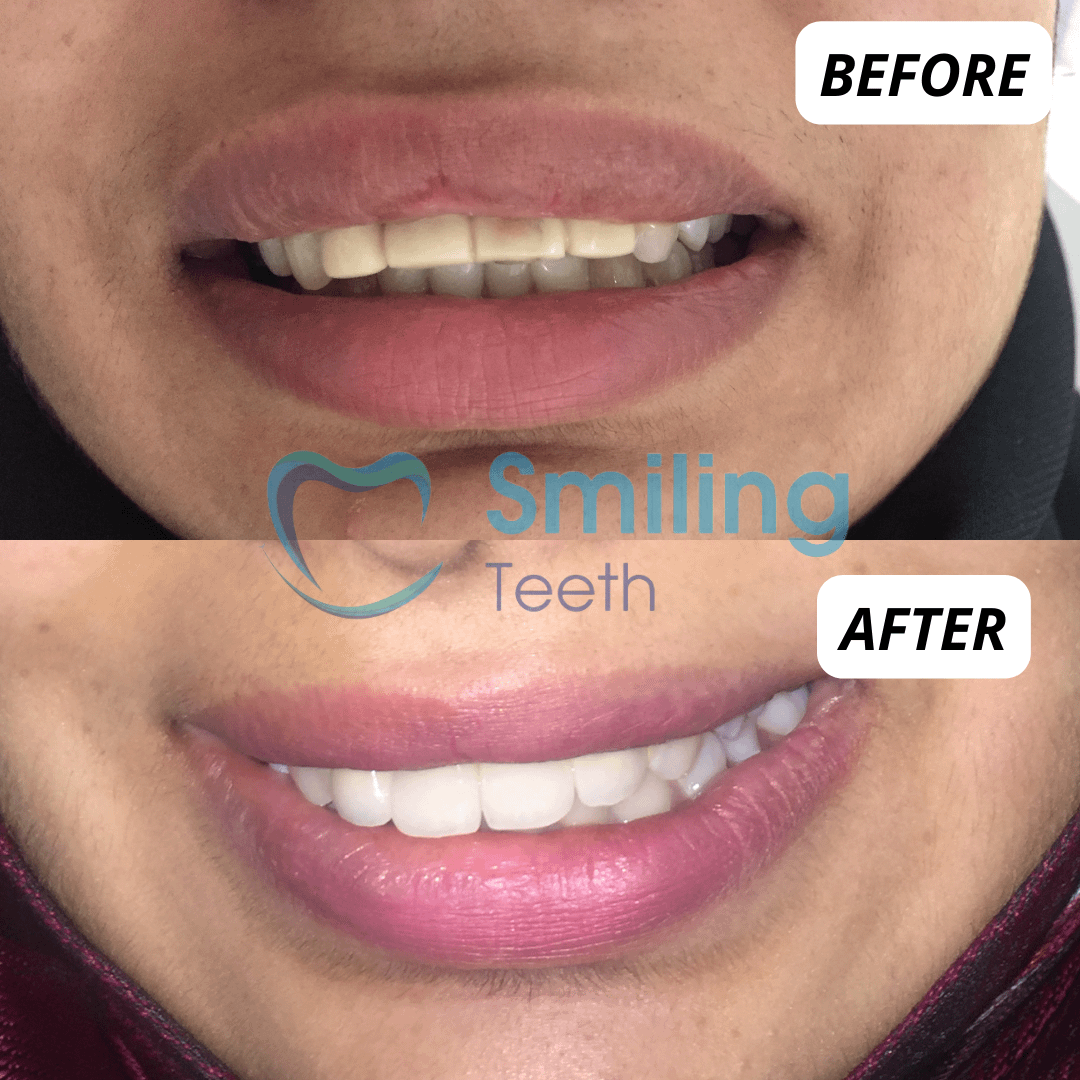 Teeth Whitening Treatment- Before and After