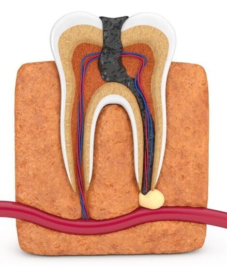 Root Canal Treatment in Mira Road, Mumbai