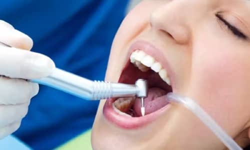 Cosmetic teeth filing and Teeth whitening