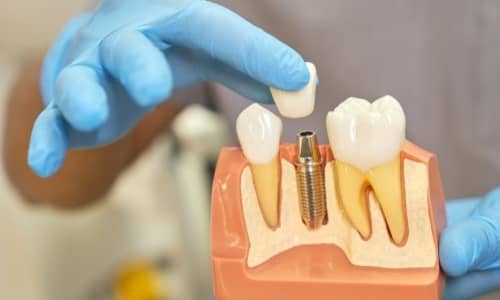 Dental Implants in Thane West