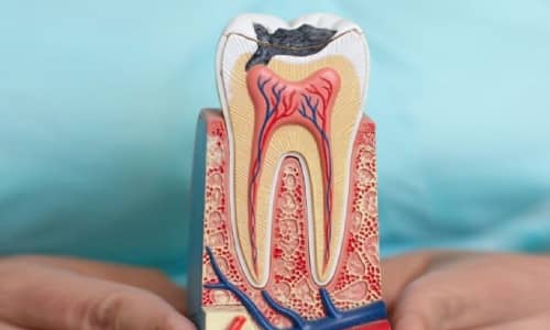 Root Canal Treatment in Thane West