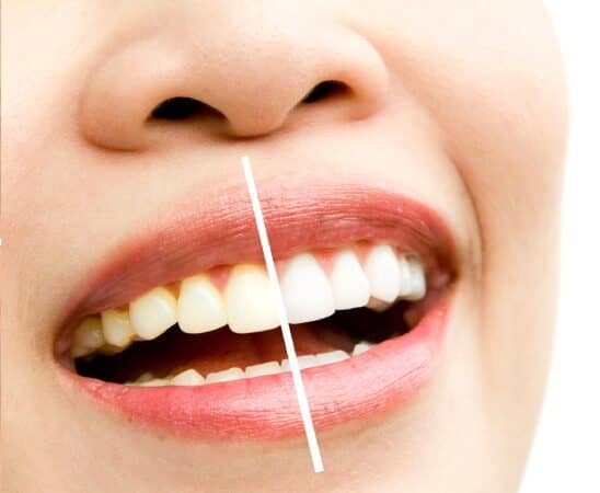 Smiling Teeth : Teeth Whitening Treatment