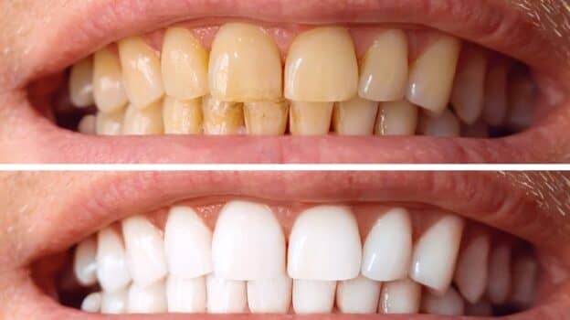 Teeth Whitening Treatment : Before & After