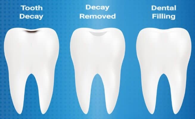 Teeth Filling Treatment in Mira Road, Mumbai