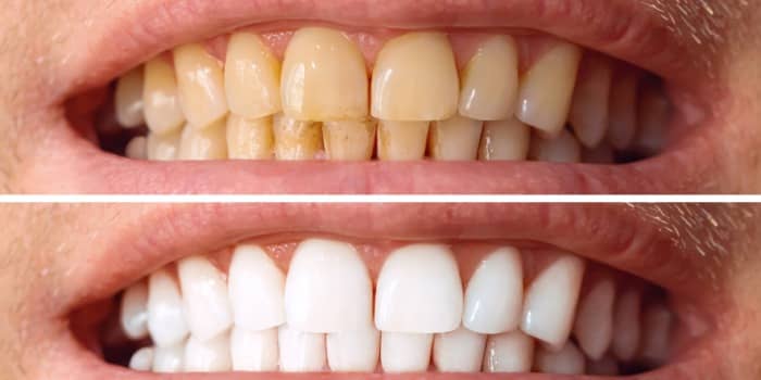 Teeth Whitening Treatment : Before & After