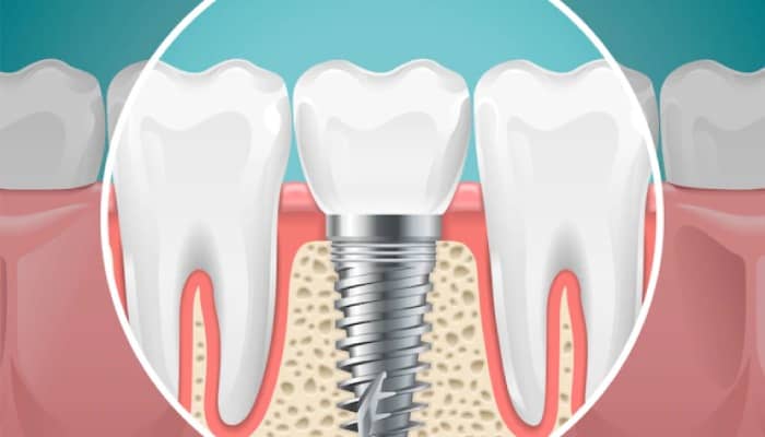 Smiling Teeth the best dental implant clinic in india