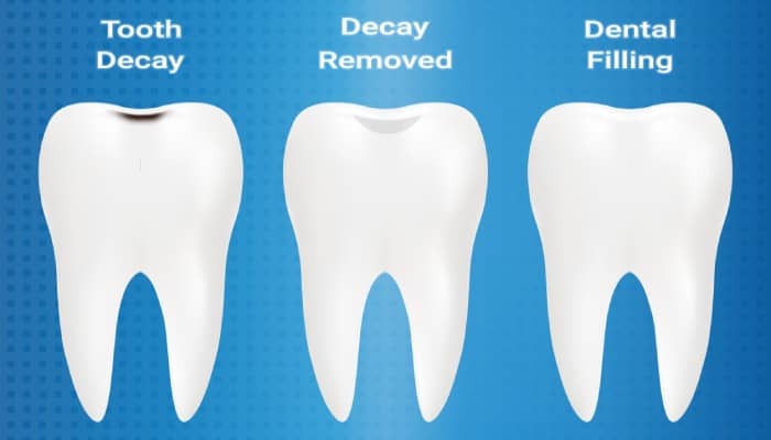 Teeth Filling Treatment in Mira Road, Mumbai