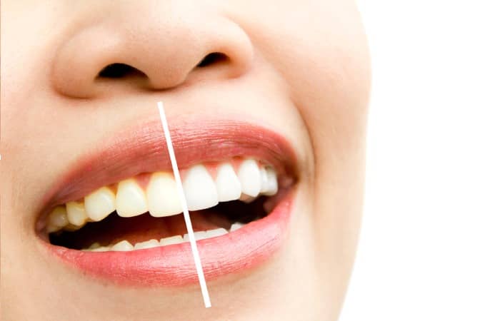 Smiling Teeth : Teeth Whitening Treatment