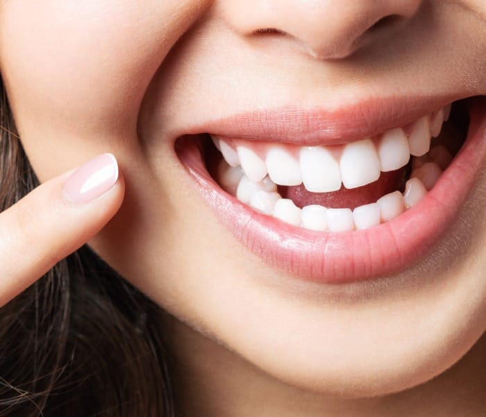 Full Mouth Rehabilitation at Smiling Teeth