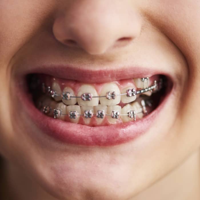 Braces| Dental Braces Treatment & Cost - Mumbai