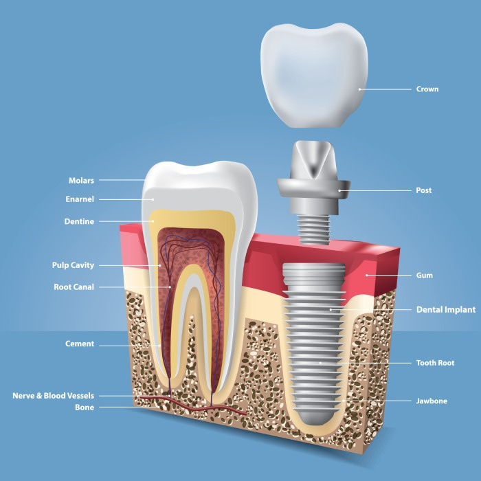 dental implants in Mira Road, Mumbai