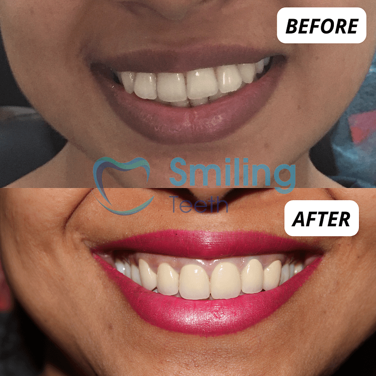 Smile Makeover - Before and After