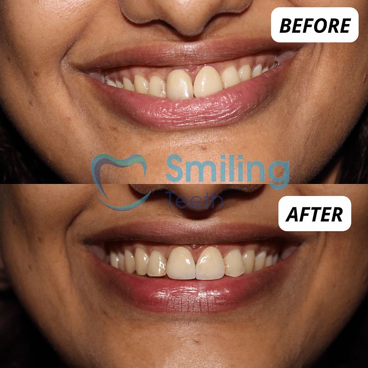 Smile Makeover Treatment- Before and After