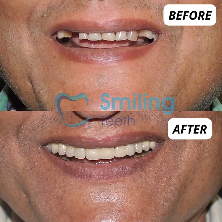 Dental Crowns and Tooth Bridges- Before And After