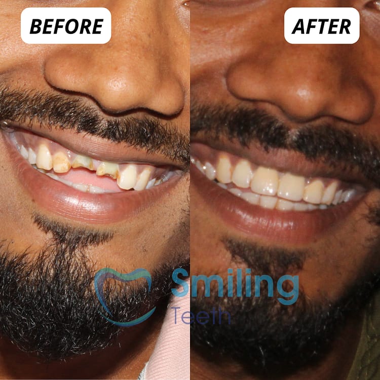 Dental Bridges to Replace Missing Teeth - Before And After