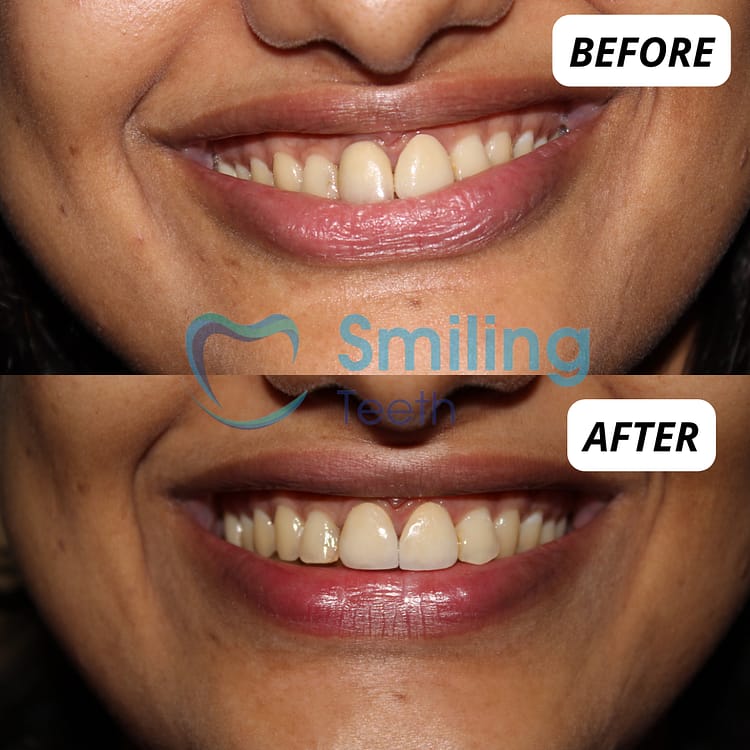 Smile Makeover Treatment- Before and After