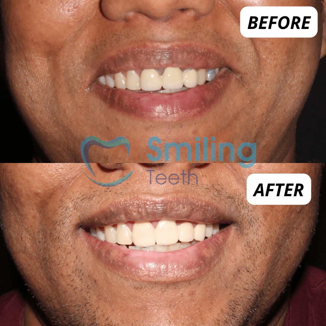 Teeth Whitening Treatment - Tooth Bleaching - Before and After