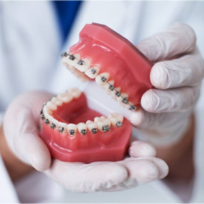 Braces| Dental Braces Treatment & Cost - Mumbai