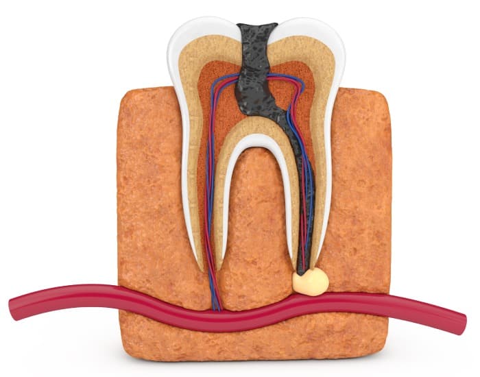 Get The Best Root Canal Treatment in Mira Road & Thane West, Mumbai