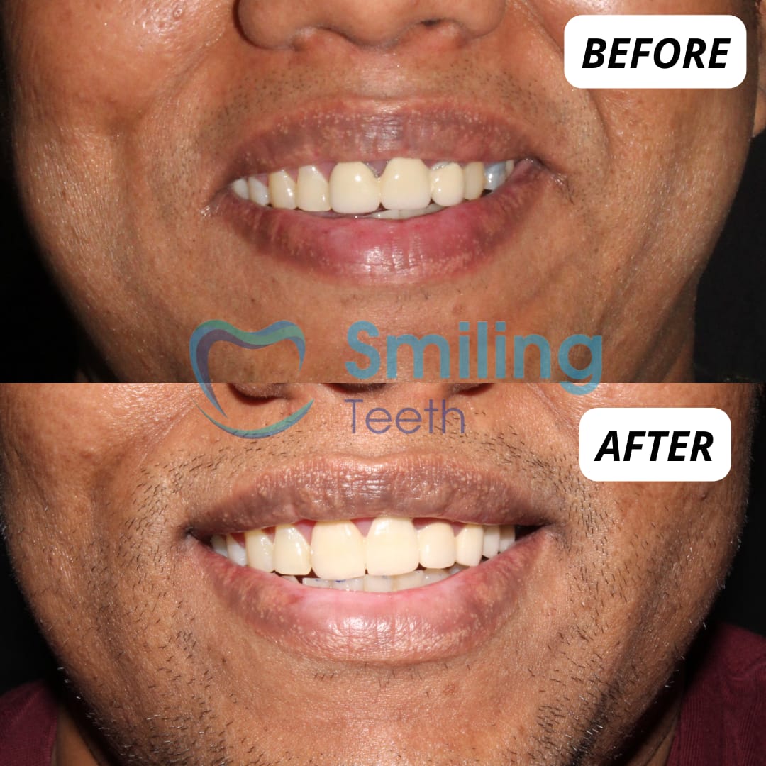 Teeth Whitening Treatment - Tooth Bleaching - Before and After