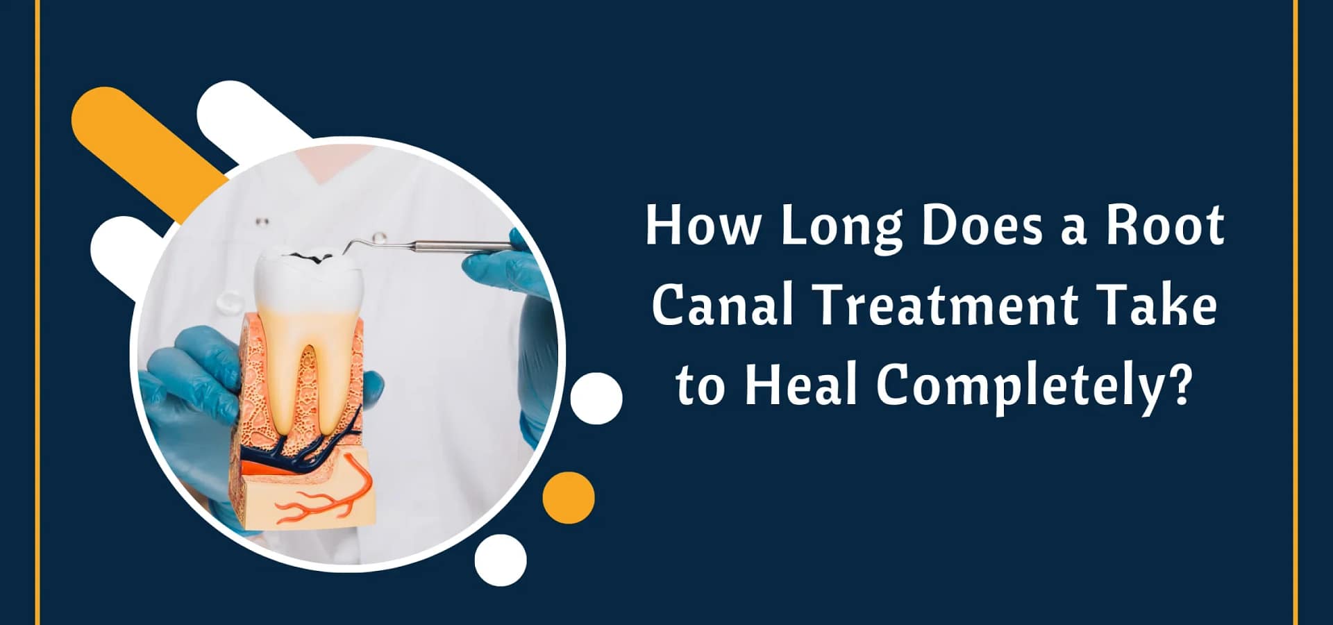 How Long Does a Root Canal Treatment Take to Heal Completely
