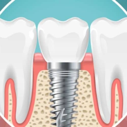 Smiling Teeth the best dental implant clinic in india